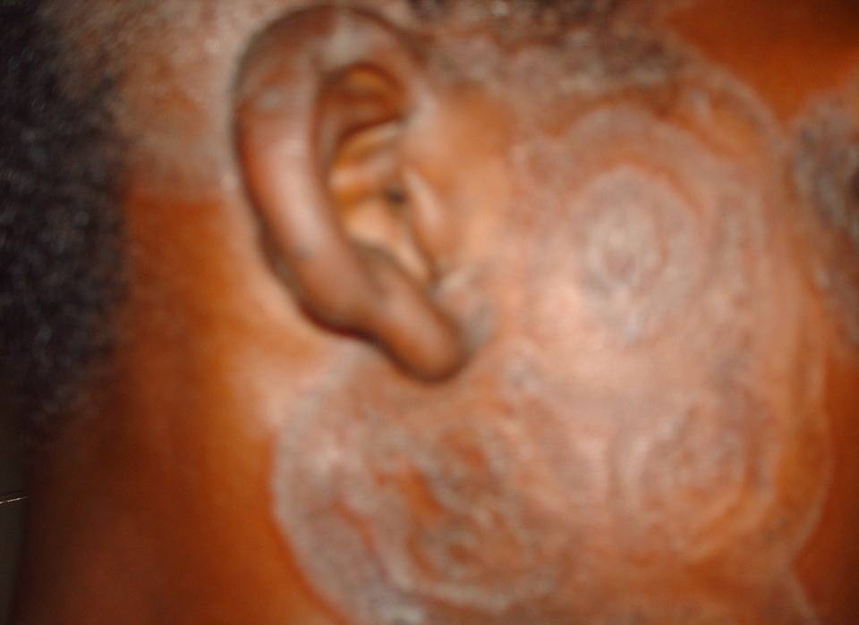 Photo médicale : Dermatophytie de la peau
