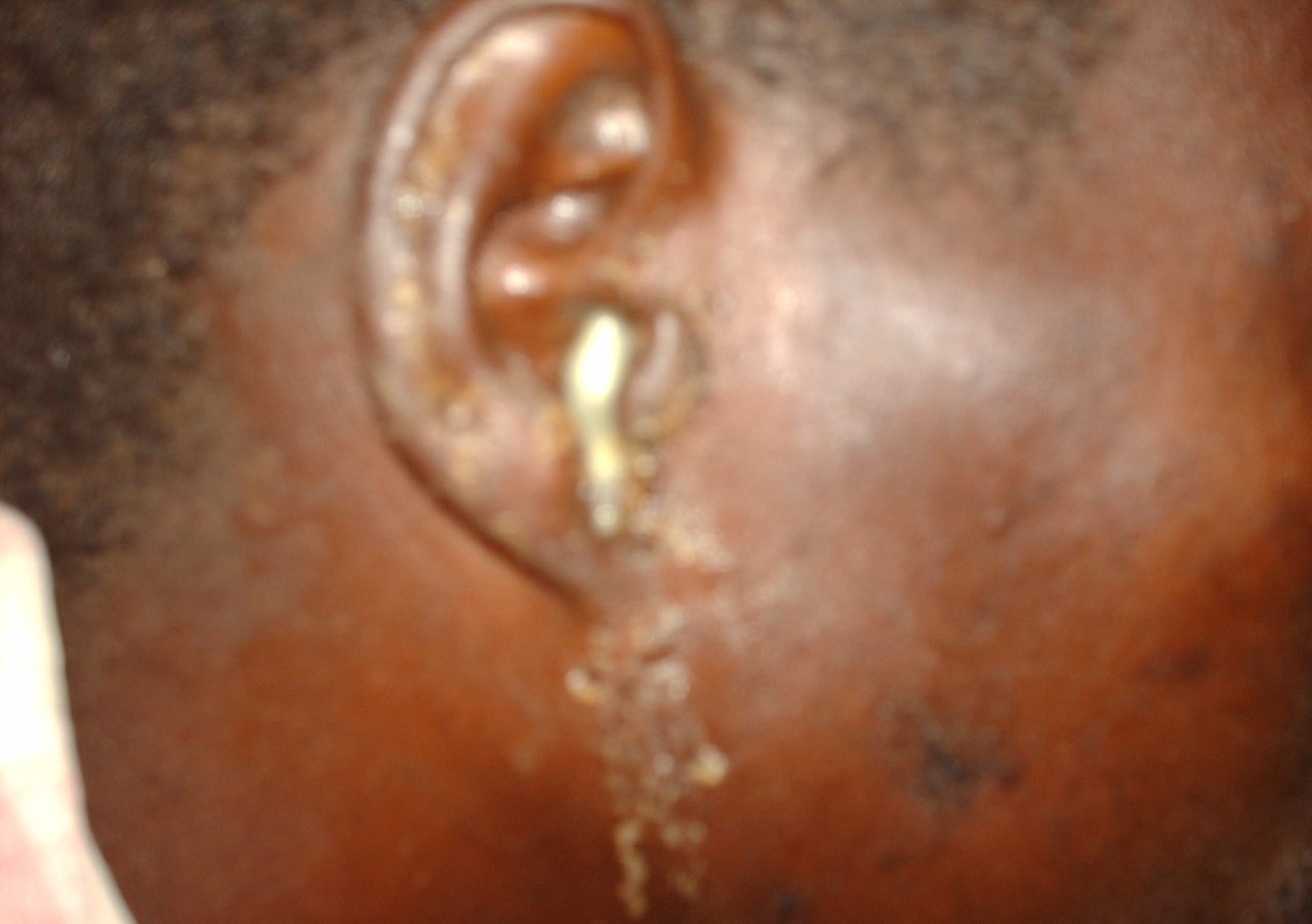 Otite