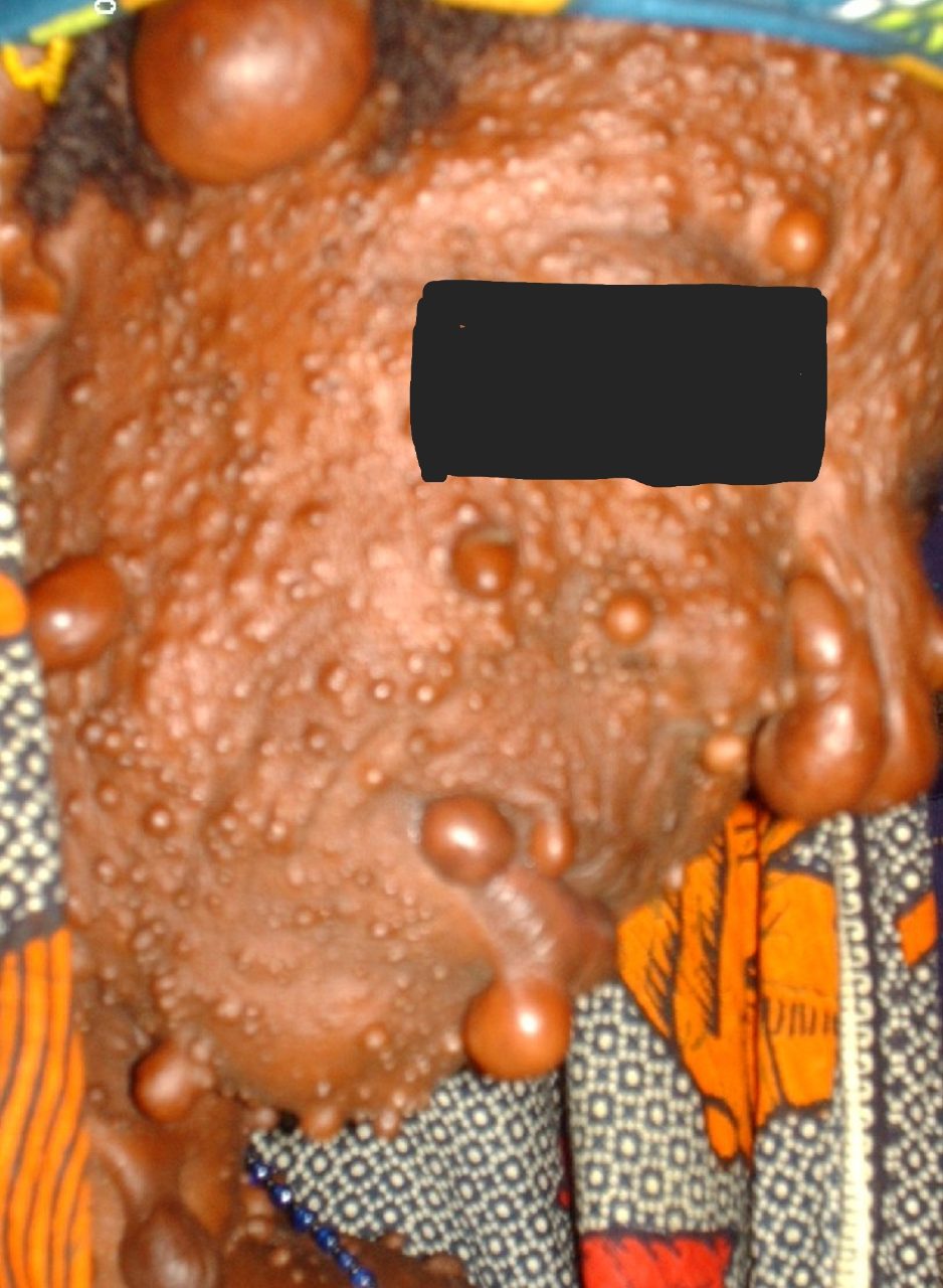 Neurofibromatose
